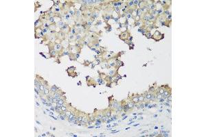 Immunohistochemistry of paraffin-embedded human prostate using NEDD4L antibody at dilution of 1:200 (40x lens). (NEDD4-2 Antikörper)