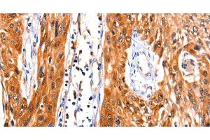Immunohistochemistry of paraffin-embedded Human esophagus cancer tissue using FBLN1 Polyclonal Antibody at dilution 1:47