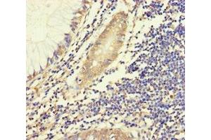 Immunohistochemistry of paraffin-embedded human colon cancer using ABIN7155943 at dilution of 1:100 (Chromosome X Open Reading Frame 27 (CXORF27) (AA 1-117) Antikörper)