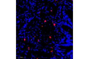Immunofluorescence of paraffin embedded human lung cancer using CST9L (ABIN7073650) at dilution of 1:900 (300x lens) (CST9L Antikörper)