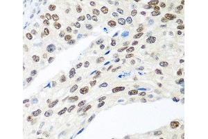 Immunohistochemistry of paraffin-embedded Human prostate cancer using MDC1 Polyclonal Antibody at dilution of 1:100 (40x lens). (MDC1 Antikörper)