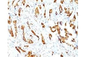 Formalin-fixed, paraffin-embedded human breast carcinoma stained with HSP27 antibody (SPM252) (HSP27 Antikörper)
