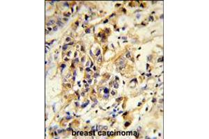 Formalin-fixed and paraffin-embedded human breast carcinoma reacted with RPGRIP1 Antibody , which was peroxidase-conjugated to the secondary antibody, followed by DAB staining. (RPGRIP1 Antikörper  (AA 530-557))