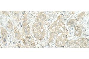 Immunohistochemistry of paraffin-embedded Human breast cancer tissue using MIEN1 Polyclonal Antibody at dilution of 1:45(x200) (C17orf37 Antikörper)