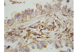Immunohistochemical staining of paraffin-embedded human lung cancer tissue section with CXCL9 polyclonal antibody . (CXCL9 Antikörper  (N-Term))