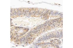 Immunohistochemistry of paraffin embedded human colon cancer using ATP1A1 (ABIN7073154) at dilution of 1: 500 (400x lens) (ATPase (Na/K) Antikörper)