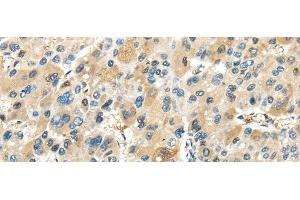 Immunohistochemistry of paraffin-embedded Human liver cancer tissue using TRAIP Polyclonal Antibody at dilution 1:40 (TRAIP Antikörper)