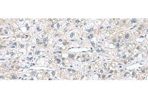 Immunohistochemistry of paraffin-embedded Human liver cancer tissue using CACNB1 Polyclonal Antibody at dilution of 1:110(x200) (CACNB1 Antikörper)