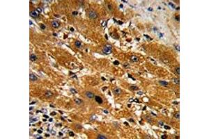 IHC analysis of FFPE human hepatocarcinoma with Caspase-9 antibody (Caspase 9 Antikörper  (Ser196))