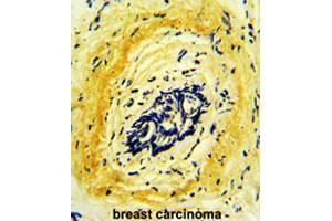 Formalin-fixed and paraffin-embedded human breast carcinomareacted with HTRA1 polyclonal antibody , which was peroxidase-conjugated to the secondary antibody, followed by AEC staining. (HTRA1 Antikörper  (AA 124-153))