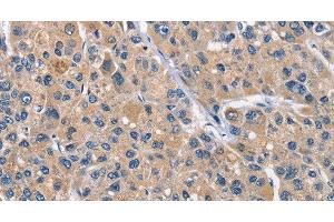 Immunohistochemistry of paraffin-embedded Human liver cancer tissue using CLEC2D Polyclonal Antibody at dilution 1:70 (CLEC2D Antikörper)