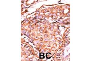 Formalin-fixed and paraffin-embedded human cancer tissue reacted with JUN (phospho S63) polyclonal antibody  which was peroxidase-conjugated to the secondary antibody followed by AEC staining. (C-JUN Antikörper  (pSer63))