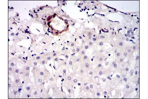 Immunohistochemical analysis of paraffin-embedded liver cancer tissues using MCAM mouse mAb with DAB staining. (MCAM Antikörper  (AA 84-189))