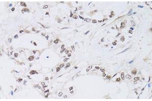Immunohistochemistry of paraffin-embedded Human gastric cancer using PAX3 Polyclonal Antibody at dilution of 1:100 (40x lens). (Paired Box 3 Antikörper)