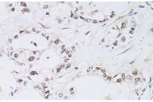 Immunohistochemistry of paraffin-embedded Human gastric cancer using PAX3 Polyclonal Antibody at dilution of 1:100 (40x lens).