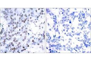 Immunohistochemistry analysis of paraffin-embedded human breast carcinoma tissue, using JunB (Ab-79) Antibody. (JunB Antikörper  (AA 46-95))