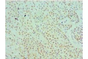 Immunohistochemistry of paraffin-embedded human breast cancer using ABIN7169345 at dilution of 1:100