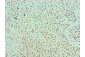 Immunohistochemistry of paraffin-embedded human breast cancer using ABIN7169345 at dilution of 1:100 (SERPINB5 Antikörper  (AA 21-189))