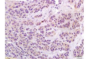 Formalin-fixed and paraffin embedded human endometrial carcinoma labeled with Anti-Notch1/MOTC Polyclonal Antibody, Unconjugated  at 1:200 followed by conjugation to the secondary antibody and DAB staining (Notch1 Antikörper  (AA 2101-2300))