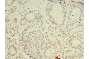 Immunohistochemistry of paraffin-embedded human breast cancer using ABIN7147697 at dilution of 1:100 (CBX2 Antikörper  (AA 1-211))
