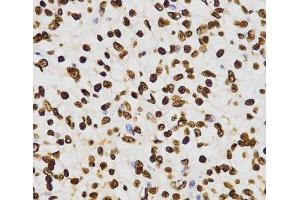 Immunohistochemistry of paraffin-embedded Human kidney cancer using DiMethyl-Histone H3-K27 Polyclonal Antibody at dilution of 1:200 (40x lens). (Histone 3 Antikörper  (2meLys27))