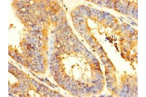 Immunohistochemistry of paraffin-embedded human endometrial cancer using ABIN7154164 at dilution of 1:100 (GPD2 Antikörper  (AA 43-727))