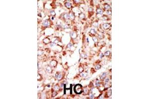 Formalin-fixed and paraffin-embedded human hepatocellular carcinoma tissue reacted with the ACSL3 polyclonal antibody  , which was peroxidase-conjugated to the secondary antibody, followed by DAB staining. (Acsl3 Antikörper  (N-Term))