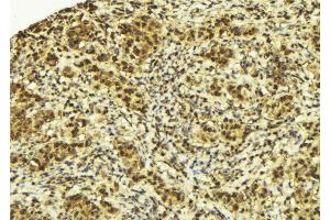 ABIN6272950 at 1/100 staining Human breast cancer tissue by IHC-P. (SPOP-B Antikörper  (Internal Region))