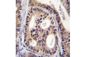 Formalin fixed, paraffin embedded human prostate carcinoma stained with CYTSA Antibody (N-term) followed which was peroxidase conjugated to the secondary antibody and followed by DAB staining. (SPECC1L Antikörper  (N-Term))