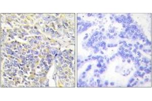 Immunohistochemistry analysis of paraffin-embedded human lung carcinoma tissue, using KAD1 Antibody .
