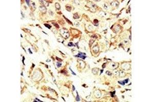 IHC analysis of FFPE human breast carcinoma tissue stained with the IGF1R antibody (IGF1R Antikörper  (AA 19-51))