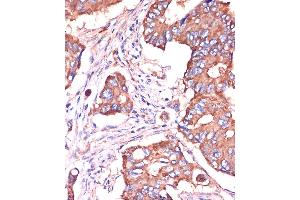 Immunohistochemistry of paraffin-embedded Human colon carcinoma using [KO Validated] IFITM3 Rabbit pAb (ABIN6130482, ABIN6142186, ABIN6142187 and ABIN7101416) at dilution of 1:100 (40x lens). (IFITM3 Antikörper  (AA 1-133))