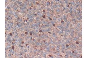 DAB staining on IHC-P; Samples: Human Skin cancer Tissue (S100A14 Antikörper  (AA 1-91))