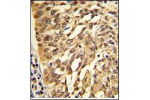 AP17730PU-N SAR1A Antibody (Center) staining of Formalin-Fixed, Paraffin-Embedded Human lung carcinoma. (SAR1A Antikörper  (Middle Region))