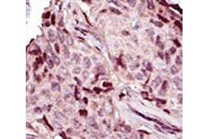 IHC analysis of FFPE human breast carcinoma tissue stained with the IRAK4 antibody (IRAK4 Antikörper  (AA 5-36))