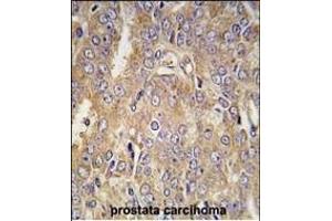 Formalin-fixed and paraffin-embedded human prostata carcinoma tissue reacted with LTBP1 antibody (C-term) (ABIN392207 and ABIN2841907) , which was peroxidase-conjugated to the secondary antibody, followed by DAB staining. (LTBP1 Antikörper  (C-Term))