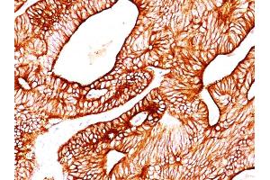 Formalin-fixed, paraffin-embedded human Colon Carcinoma stained with Cytokeratin 8/18 Monoclonal Antibody (KRT8/803 + KRT18/835). (KRT8, KRT18 Antikörper)