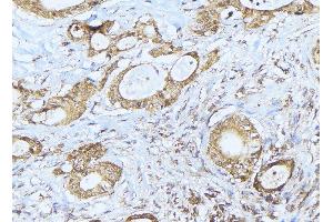 ABIN6275239 at 1/100 staining Human lung cancer tissue by IHC-P. (MRPS36 Antikörper)