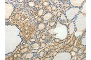 The image on the left is immunohistochemistry of paraffin-embedded Human thyroid cancer tissue using ABIN7192532(SLC9A3 Antibody) at dilution 1/20, on the right is treated with synthetic peptide. (SLC9A3 Antikörper)