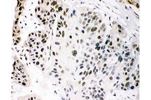 IHC-P staining of human oesophagus squama cancer tissue