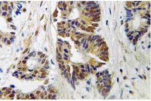 Immunohistochemistry (IHC) analyzes of GRK 2 antibody in paraffin-embedded human colon carcinoma tissue. (GRK2 Antikörper)
