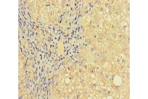 Immunohistochemistry of paraffin-embedded human liver cancer using ABIN7164277 at dilution of 1:100 (PRICKLE4 Antikörper  (AA 1-240))