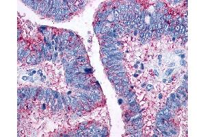 Anti-CCR10 / GPR2 antibody IHC of human Colon, Carcinoma. (CCR10 Antikörper  (Extracellular Domain))