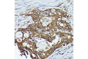 Immunohistochemistry of paraffin-embedded human colon carcinoma using FERMT2 Rabbit pAb (ABIN6131926, ABIN6140582, ABIN6140583 and ABIN6224757) at dilution of 1:300 (40x lens). (FERMT2 Antikörper  (AA 380-550))