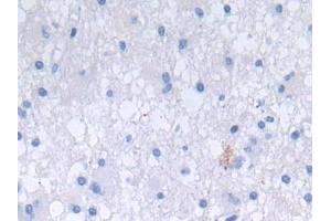 Detection of DEFa3 in Human Glioma Tissue using Polyclonal Antibody to Defensin Alpha 3, Neutrophil Specific (DEFa3) (DEFa3 Antikörper  (AA 21-94))