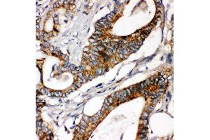 Anti-Laminin gamma 1 antibody, IHC(P) IHC(P): Human Intestinal Cancer Tissue (Laminin gamma 1 Antikörper  (C-Term))