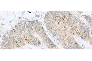 Immunohistochemistry of paraffin-embedded Human colorectal cancer tissue using MLNR Polyclonal Antibody at dilution of 1:35(x200)