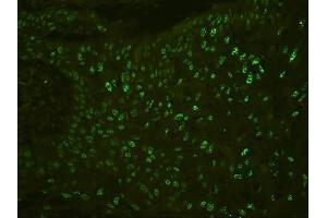 IF analysis of PHF21A using anti-PHF21A antibody (ABIN6719353) PHF21A was detected in paraffin-embedded section of human oesophagus squama cancer tissues.