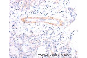 Immunohistochemistry of Human breast cancer using TPM1 Polyclonal Antibody at dilution of 1:40 (Tropomyosin Antikörper)