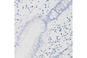 Immunohistochemistry of paraffin-embedded Human intestinal adenocarcinoma (negative control samples) using PD-L1/CD274/CD274 Rabbit mAb (ABIN7266181) at dilution of 1:200 (40x lens). (PD-L1 Antikörper  (Extracellular Domain))